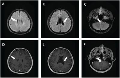 Case report: Case analysis of multiple sclerosis with preclinical systemic lupus erythematosus presenting as rare bilateral horizontal gaze palsy